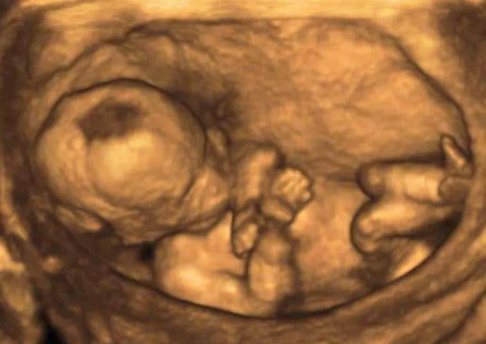 Echographie 3d Bébé In Utero