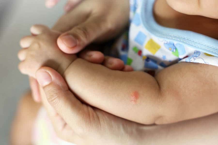 Piqure Insecte Sur Bras De Bébé