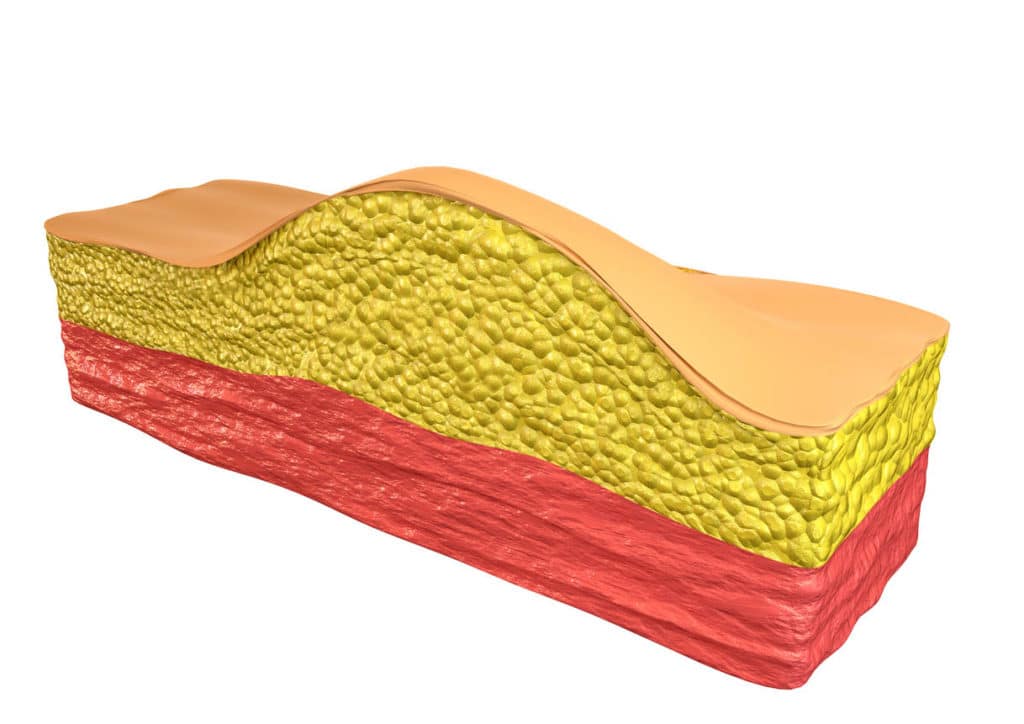 Lipome - une tumeur bénigne composée de cellules de tissu adipeux (adipocytes)
