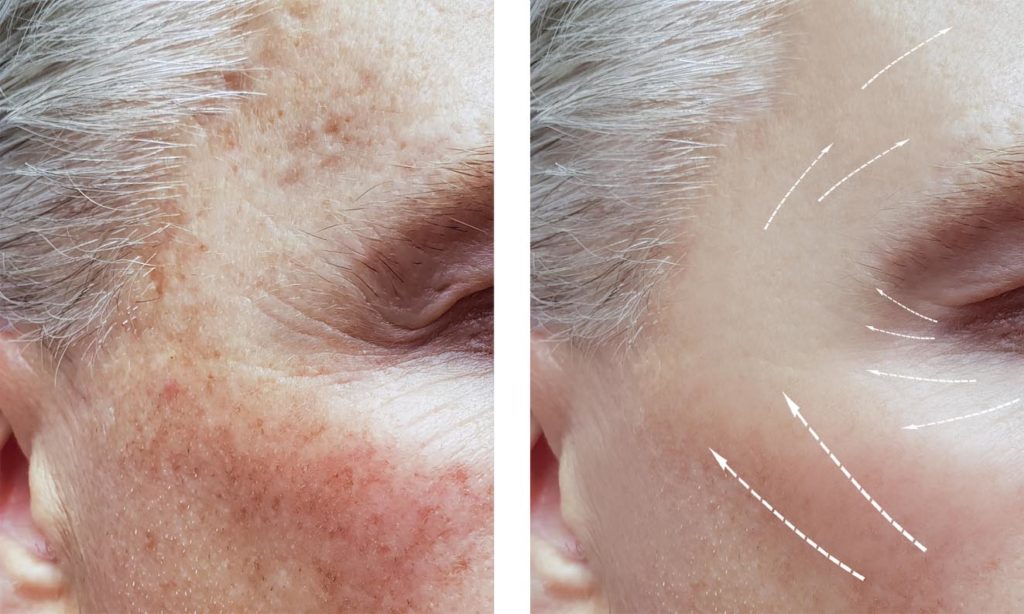 taches brune du visage masculin avant et après les traitements, pigmentation 