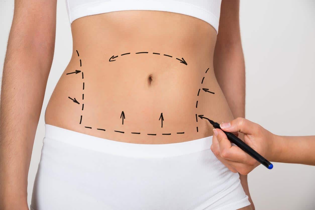 dessin à la main sur une femme de l'Abdomen avant une liposuccion