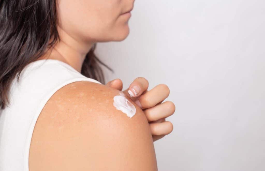 fille peau problème avec taches brunes sur l'épaule applique une crème 