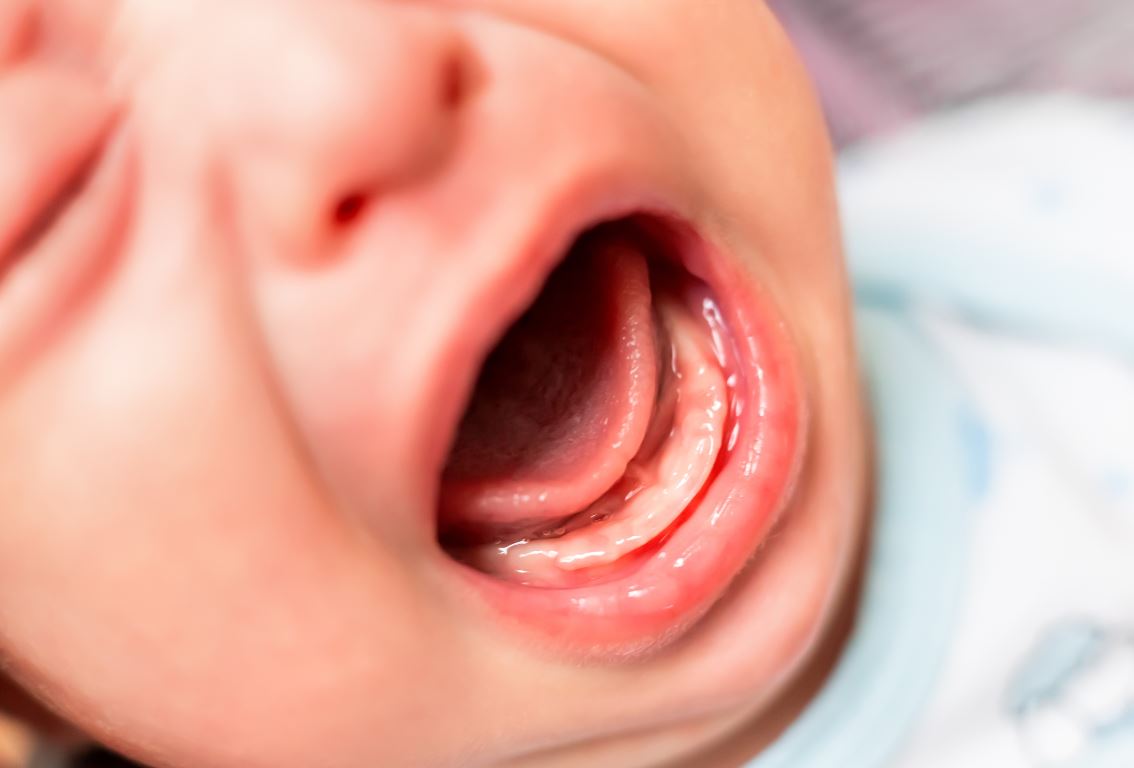 Doublement gencives chez bébé Causes, symptômes, traitements — free download