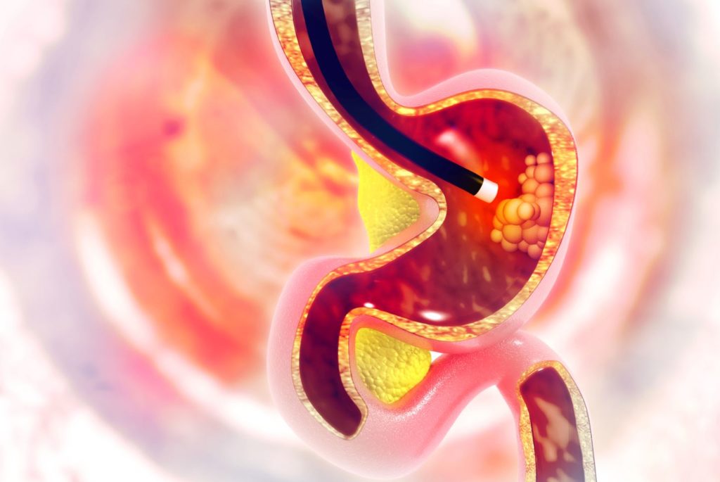 Endoscopie 