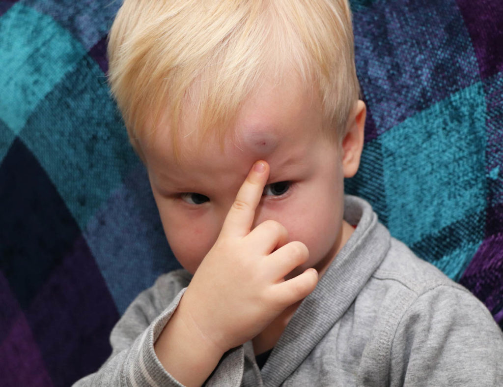 Mon Enfant S Est Cogne La Tete Que Faire Et Comment Reagir