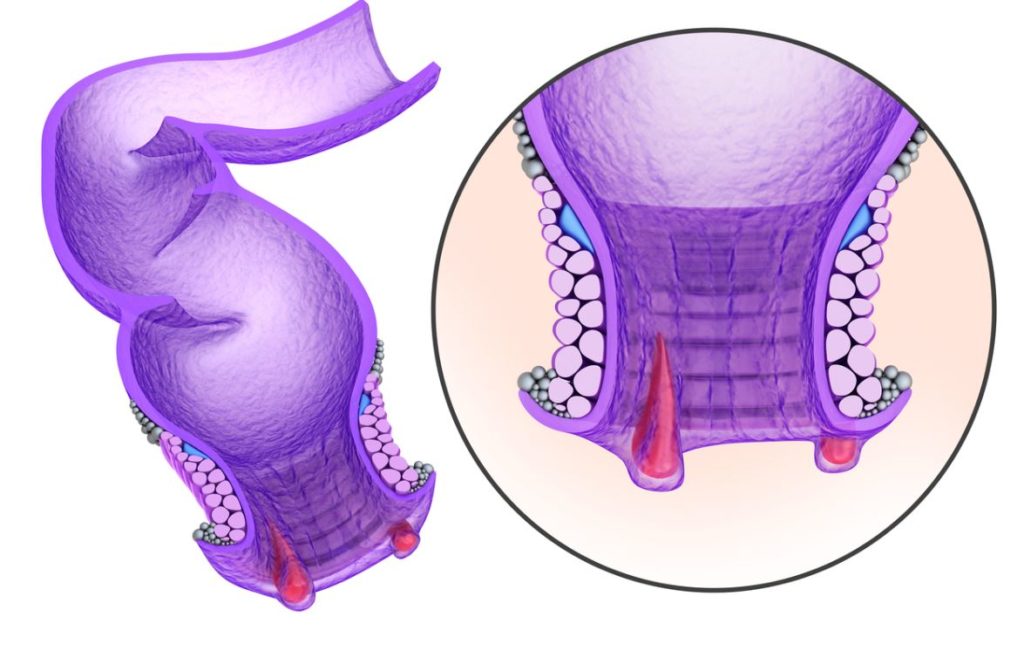 Fistule Anale Chirurgie