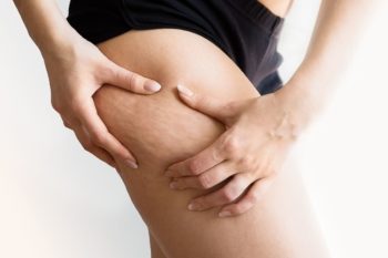 Cellulite Femme