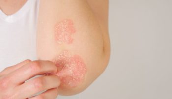 Radiodermite Peau