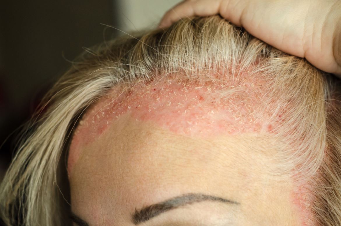 Psoriasis du cuir chevelu le reconnaître pour bien le soigner