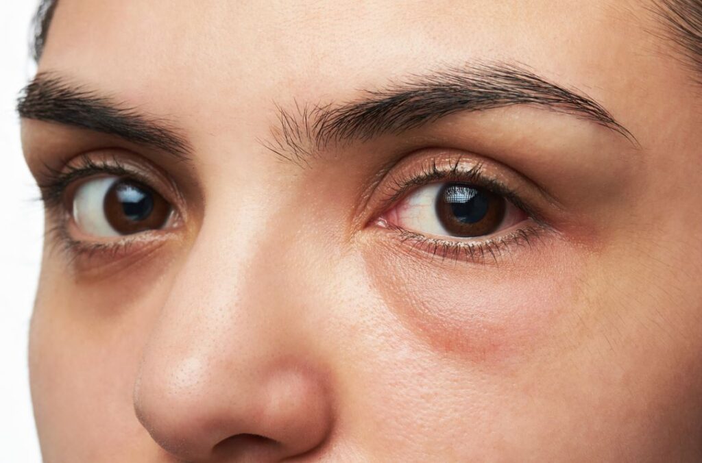 Poches Sous Les Yeux
