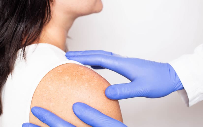 Vitiligo Diagnostic