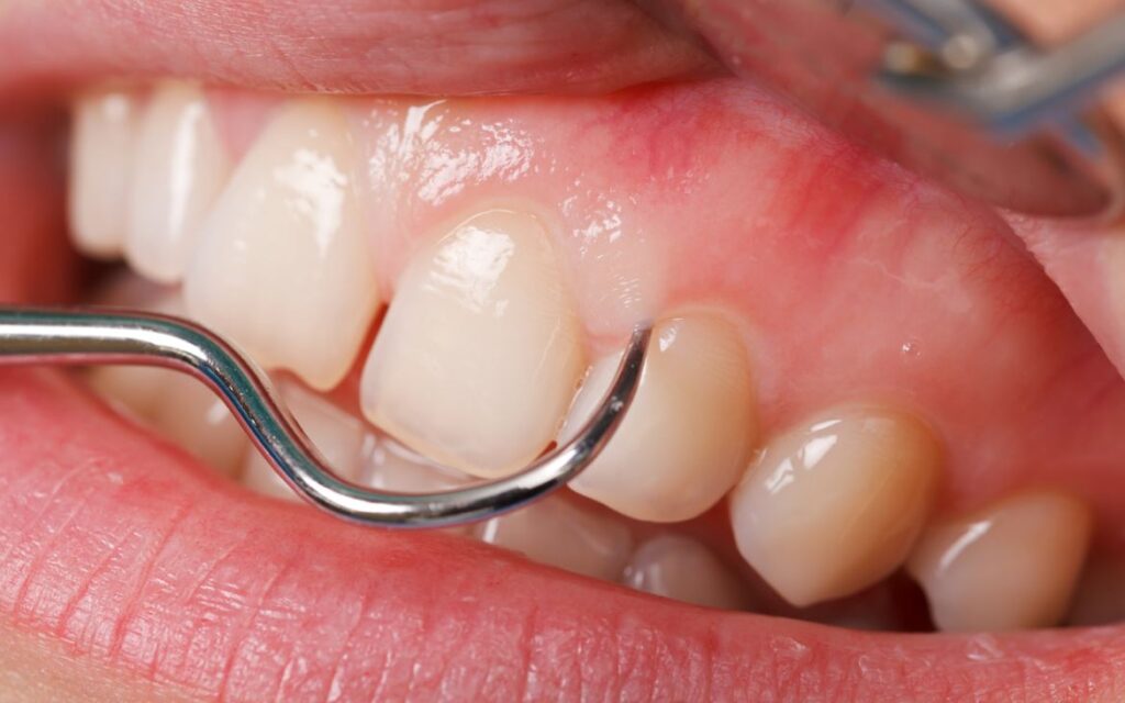 Dents Greffe Gencives