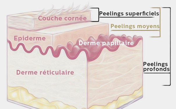 Zones Intervention Des Différents Peelings Schéma