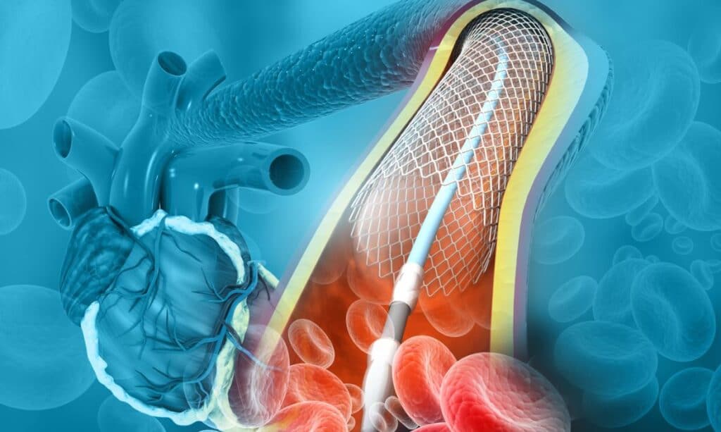 Angioplastie Infarctus