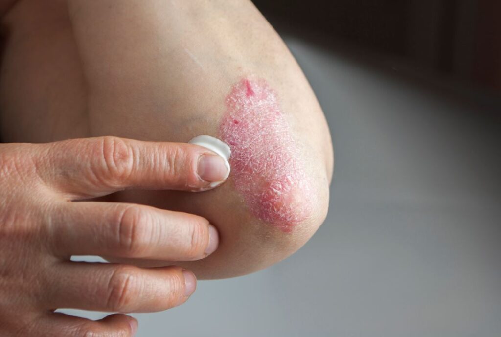 Psoriasis Coude