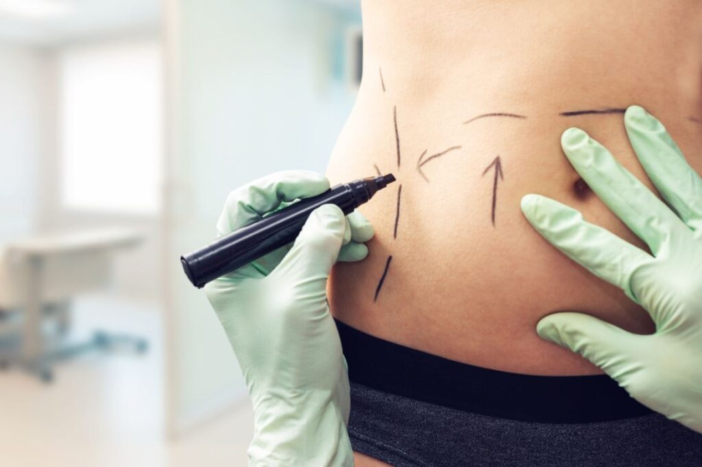 Chirurgie Ventre