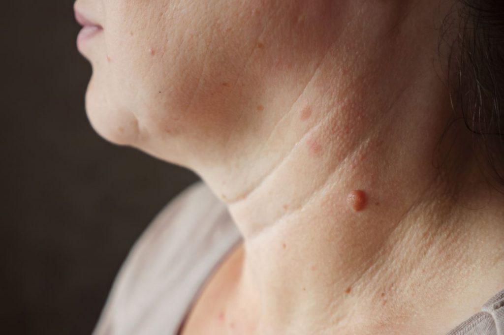 Verrue séborrhéique causes et traitements adaptés