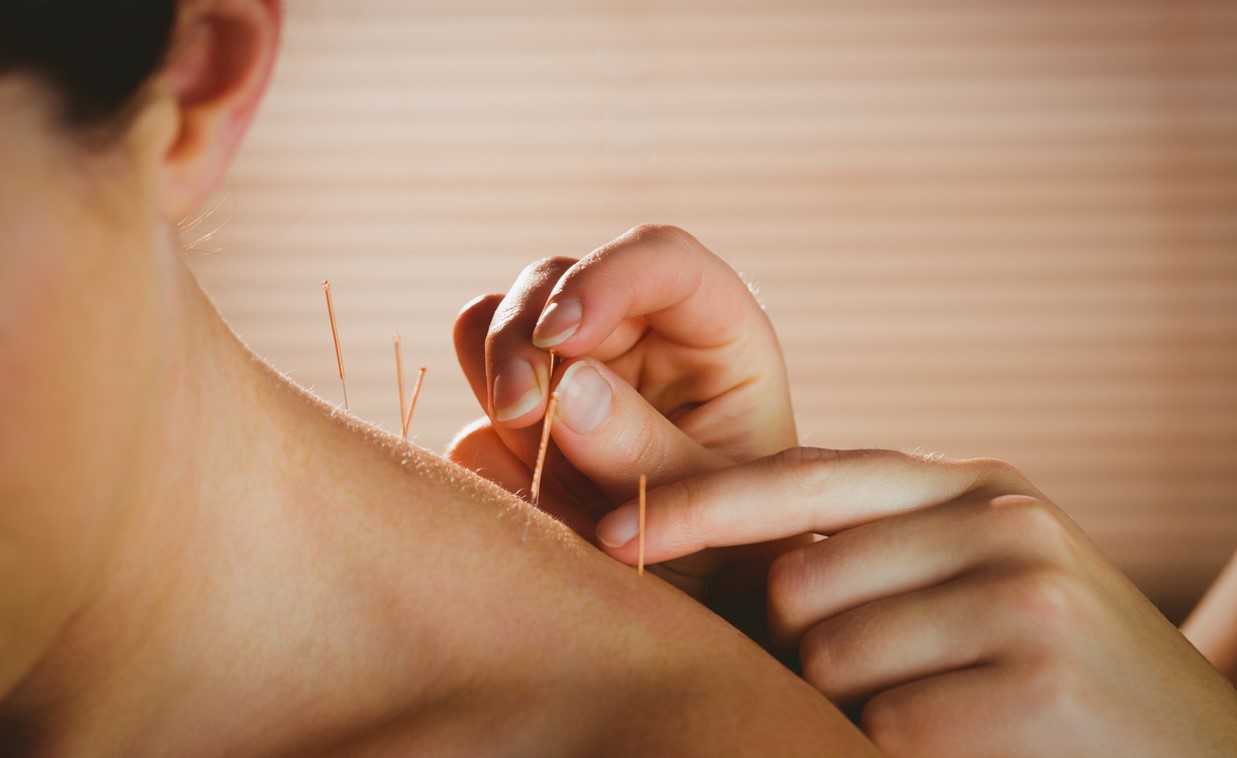 Acupuncture