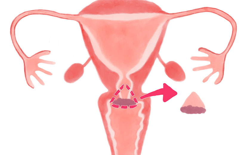 Conisation Col Uterus