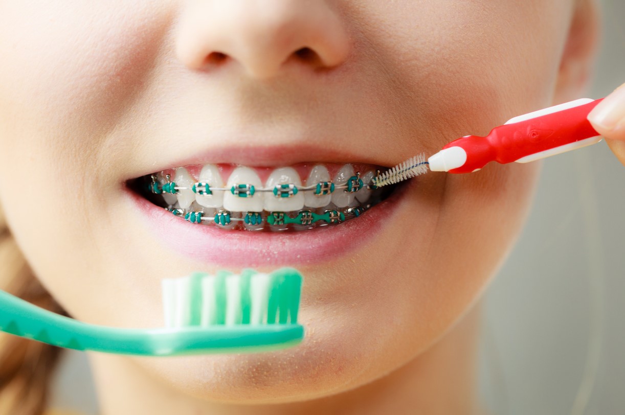 Brosser Dents Appareil Dentaire