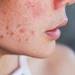 Avec avec des problèmes de peau sur le visage
