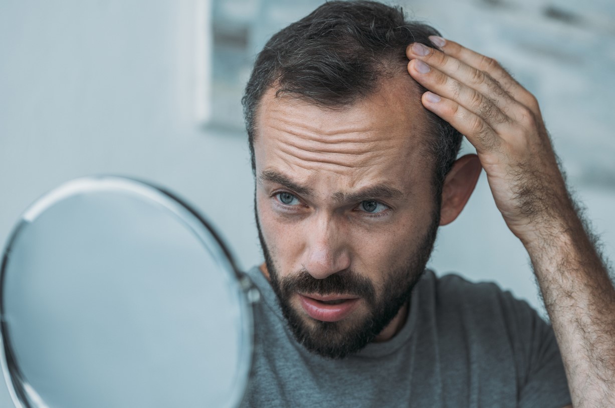 Perte Cheveux Hommes