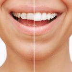 Hollywood Smile