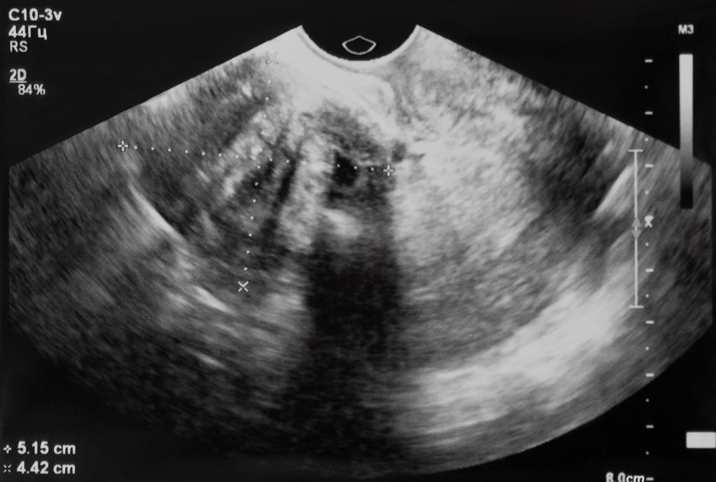 Ecran Echographie